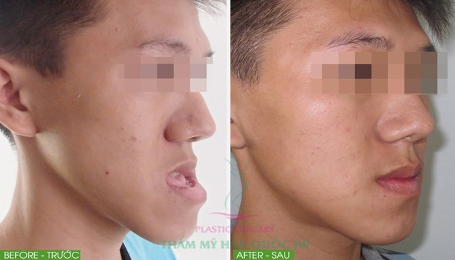 Phẫu thuật thẩm mỹ đã thay đổi cuộc đời tôi Anh Khoa chàng trai không thể khép miệng đã được TS-BS Tú Dung phẫu thuật thành công.
