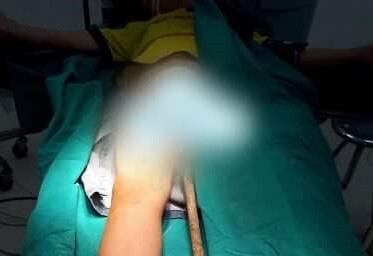 Bản tin 20H: Hy hữu bé trai bị thanh sắt dài 60cm đâm xuyên cơ thể Thanh sắt đâm xuyên cơ thể cháu bé từ phía dưới.