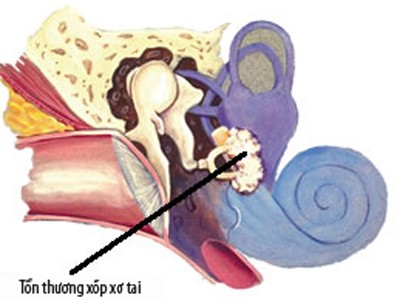 Hội chứng xốp xơ tai có thể gây điếc Hội chứng xốp xơ tai có thể gây điếc