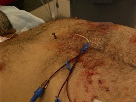 Đinh xuyên tim vẫn sống sót Chiếc đinh dài 10 cm đâm trúng tâm thất phải của anh Dennis Hennis