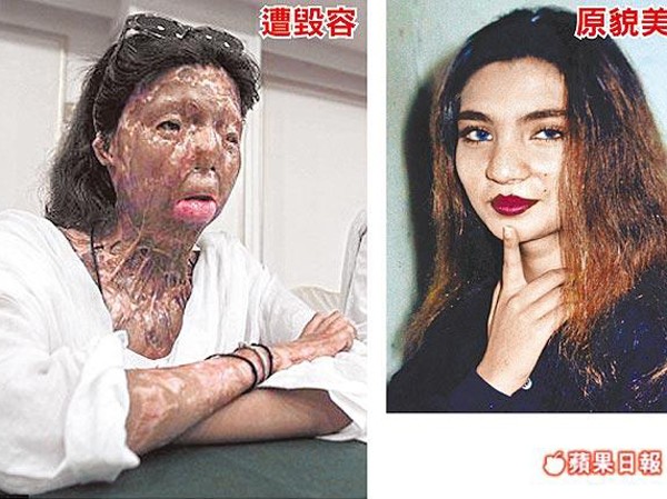 Vụ tự tử gây chấn động dư luận Fakhra trước và sau khi bị chồng tạt a-xít