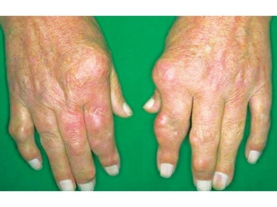 Viêm đa khớp dạng thấp Viêm đa khớp dạng thấp