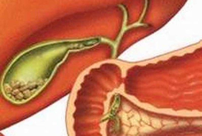 4 cách đơn giản phòng bệnh sỏi mật 4 cách đơn giản phòng bệnh sỏi mật