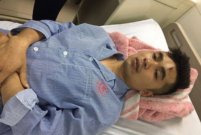 Nạn nhân vụ nổ xe khách: Người tôi đập lên đập xuống như điện giật Nạn nhân bị thương, cháy tóc sau vụ nổ.