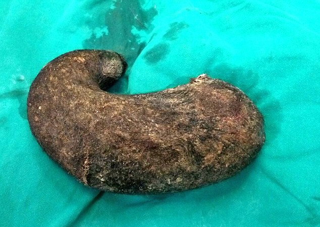 Búi tóc nặng 1kg trong bụng thiếu nữ 15 tuổi Khối tóc kết nặng hơn 1kg trong bụng bệnh nhân 15 tuổi.
