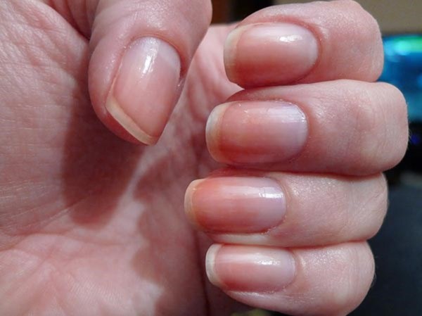 Những biểu hiện của móng tay tiết lộ sức khỏe của bạn Những biểu hiện của móng tay tiết lộ sức khỏe của bạn