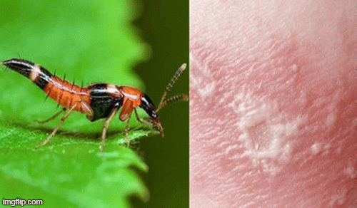 Kiến hôi có thể gây đậu mùa và kiết lỵ không?
