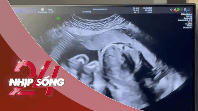 NHỊP SỐNG 24: 30 ngày diệu kỳ bác sĩ Việt cứu thai nhi trong bụng người mẹ Singapore