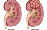 Thực hư chuyện "hạ độ" suy thận mà không cần chạy thận - Đọc xong thất kinh…