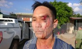 Vừa tố cáo cán bộ địa chính nhận hối lộ, một người dân bị đánh rách mặt