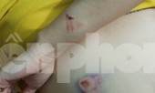 Thai phụ bị đánh hội đồng phải nhập viện cấp cứu