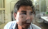 Nhân viên cây xanh bị đánh bầm dập, vỡ hàm khi chụp ảnh hiện trường