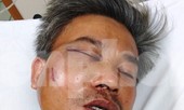Nhân viên cây xanh bị đánh bầm dập: Nạn nhân phẫu thuật khẩn cấp do vỡ xương hàm