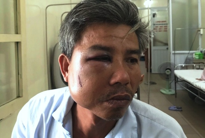 Khuôn mặt biến dạng của nạn nhân Lê Song Toàn do bị hành hung dã man trước quán cà phê trong lúc thực thi nhiệm vụ.