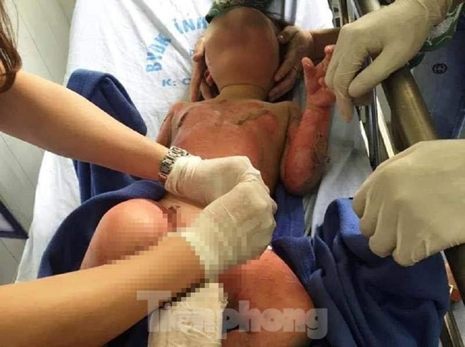 Tình tiết mới vụ 3 cháu bé mầm non bị bỏng khi học kỹ năng - ảnh 2