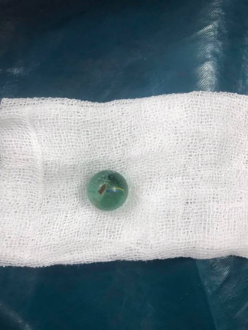 Cứu sống bé gái 6 tuổi nuốt viên bi vào khí quản - ảnh 2