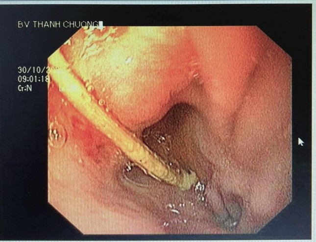 Ngậm tăm dài 5cm nằm xem ti vi rồi ngủ quên, nuốt luôn vào dạ dày ảnh 1