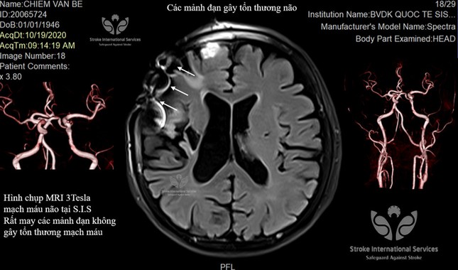 Gắp hàng trăm mảnh đạn trong đầu một thương binh ảnh 1
