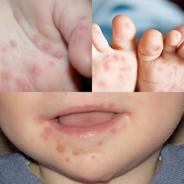 Ghi nhận bệnh nhi thứ 4 ở Đắk Lắk tử vong vì bệnh tay chân miệng ảnh 1