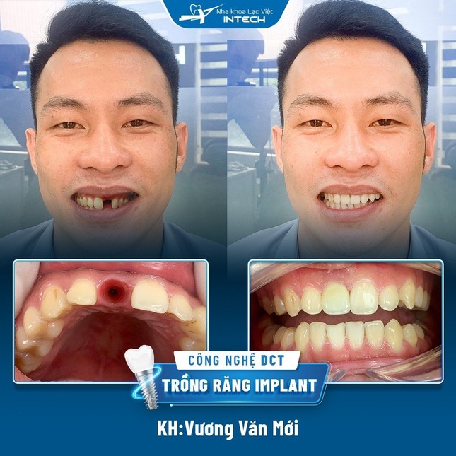 Tầm quan trọng của trụ phục hình cá nhân hoá trong cấy ghép implant ảnh 2