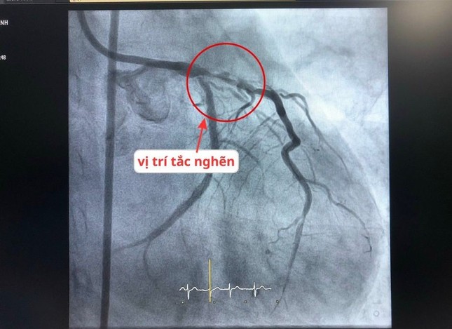 Căng não đặt 2 stent cứu sống bệnh nhân tái phát hẹp mạch vành tại vị trí khó ảnh 1