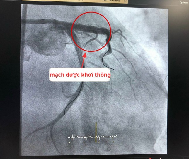 Căng não đặt 2 stent cứu sống bệnh nhân tái phát hẹp mạch vành tại vị trí khó ảnh 2