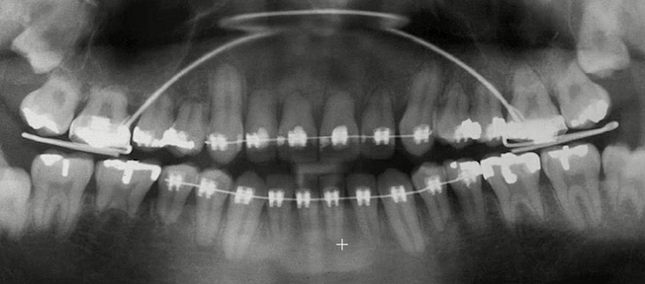 Răng lung lay bất thường khi niềng: Cảnh giác với các biến chứng nguy hiểm! ảnh 1