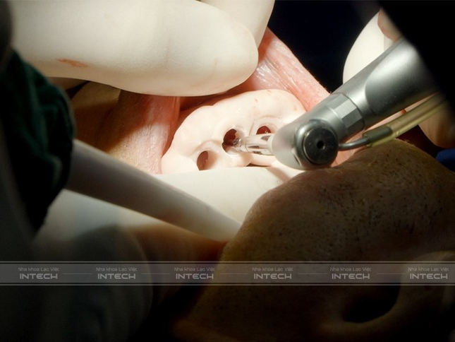 Công nghệ DCT - Bước tiến mới trong cấy ghép implant ảnh 1