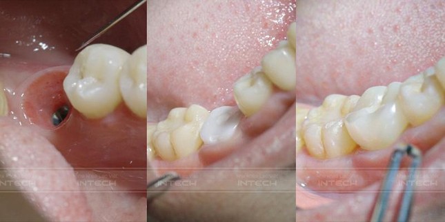 Công nghệ DCT - Bước tiến mới trong cấy ghép implant ảnh 3