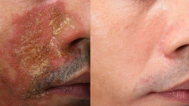 Phòng khám da liễu DRH Clinic chi hàng trăm triệu hỗ trợ điều trị viêm da miễn phí cho bệnh nhân ảnh 3