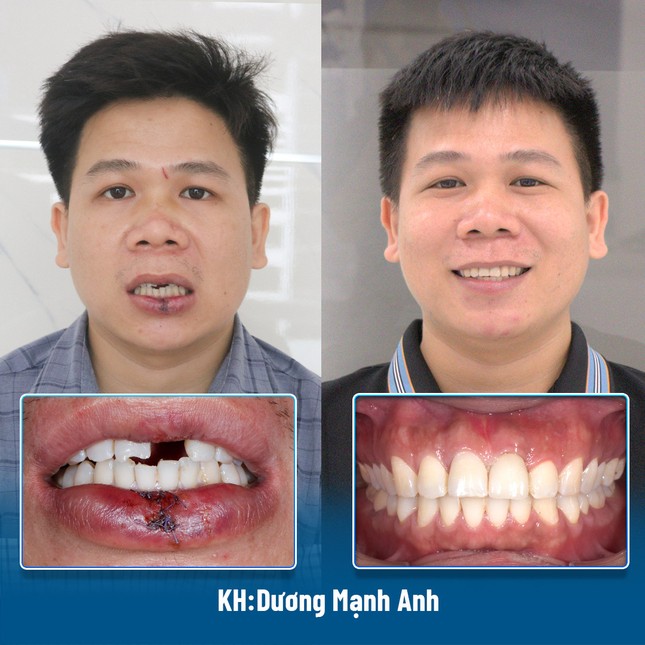 Bí quyết thành công của công nghệ trồng răng implant DCT ảnh 1