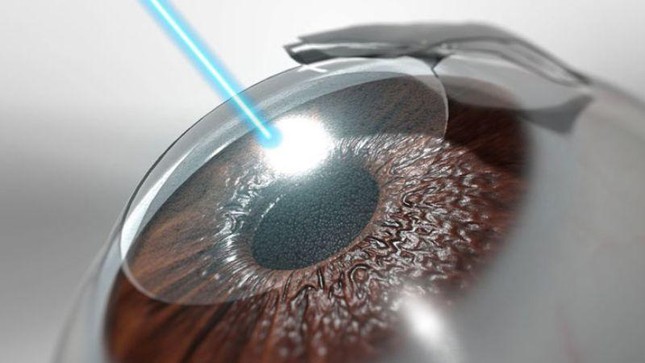 Phẫu thuật Lasik là gì, mổ cận thị bằng phương pháp Lasik có an toàn không? ảnh 1