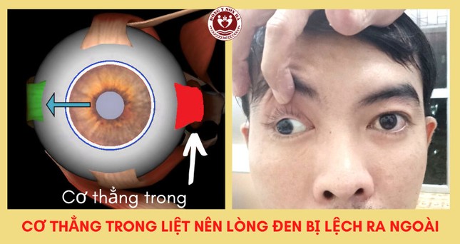 Mắt lác ngoài: Nguyên nhân, biểu hiện, phương pháp điều trị ảnh 2