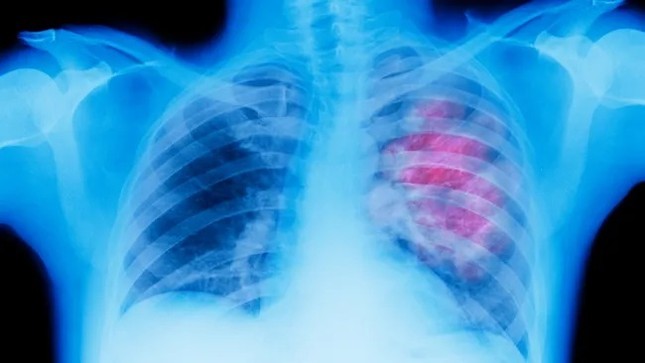 Không hút thuốc lá vẫn có nguy cơ cao mắc ung thư phổi? ảnh 1