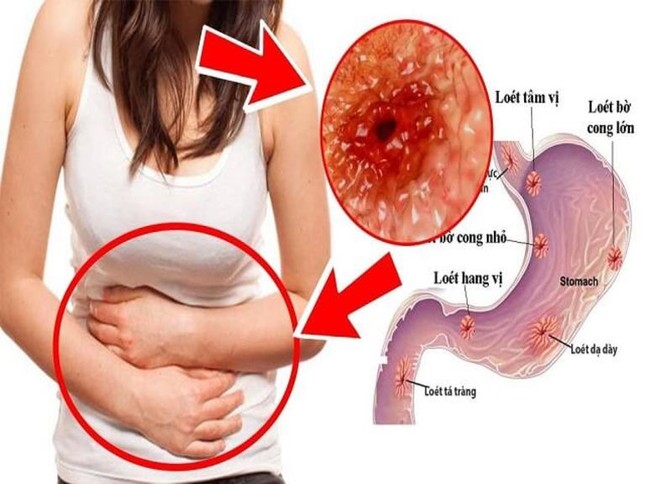 Đau dạ dày nên tránh tuyệt đối những thực phẩm này kẻo ngày càng đau, máu chảy 'ồ ạt' ảnh 1