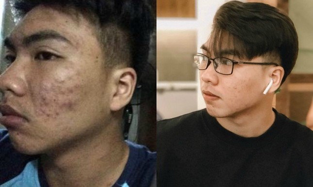 Hành trình của chàng trai 19 tuổi nói lời tạm biệt với mụn - người bạn “không muốn thân” ảnh 1