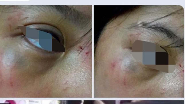 Bị nhóm bạn quây đánh hội đồng, nữ sinh lớp 8 ở Thanh Hóa phải nhập viện ảnh 3