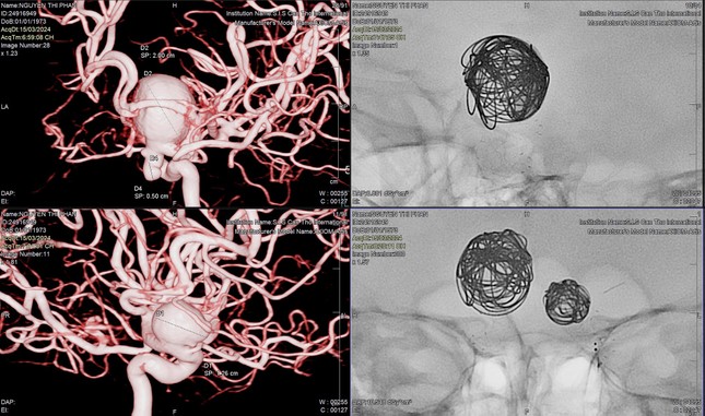 Các bác sĩ xin tiền cứu bệnh nhân nghèo có 3 'quả bom nổ chậm' trong đầu ảnh 1