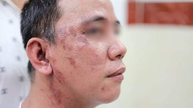 Hàng loạt bệnh nhân nhiễm loại độc gấp 15 lần nọc rắn hổ mang ảnh 2