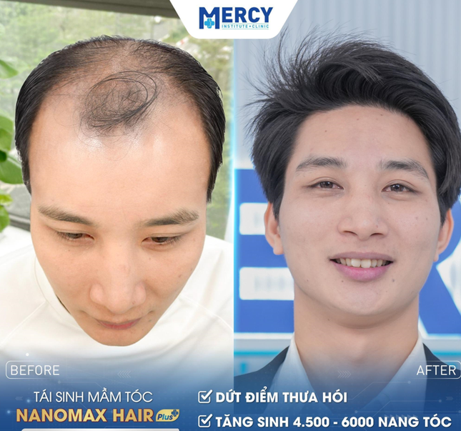 Trị rụng tóc hói đầu Nanomax Hair Plus giá bao nhiêu? ảnh 4