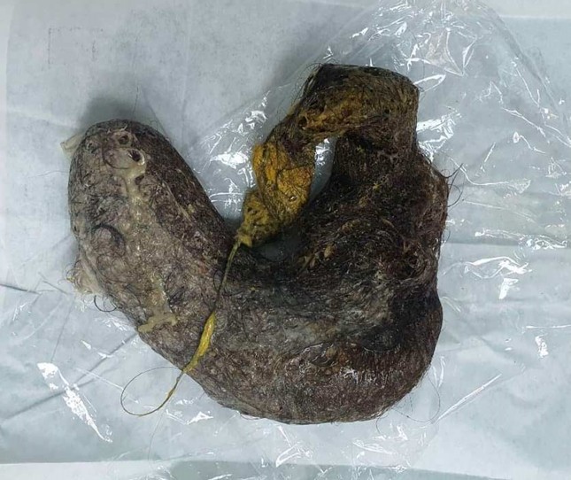 Lấy búi tóc nặng 700 gram trong bụng bé gái ‘nghiện ăn tóc’ ảnh 1