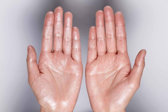 Cách khắc phục chứng ra mồ hôi tay đơn giản không thể ngờ ảnh 2