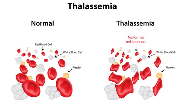 Bác sĩ chỉ cách tránh cho con bạn không bị bệnh tan máu bẩm sinh Thalassemia ảnh 1