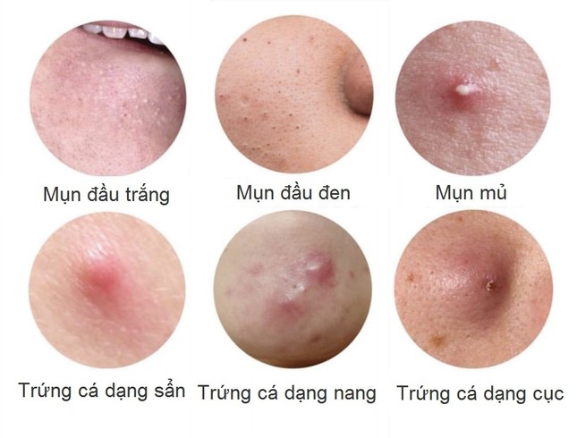 Muốn trị mụn tận gốc phải hiểu đúng về từng loại mụn ảnh 2