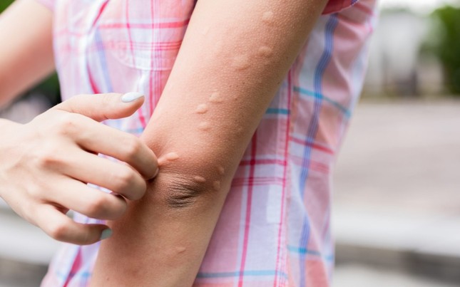 Bác sỹ cảnh báo vết đốt nhỏ từ côn trùng cũng có thể gây chết người ảnh 2