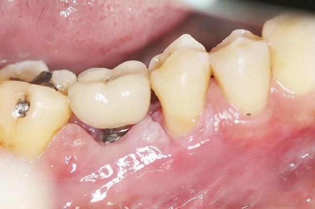 Giắt thức ăn sau khi trồng răng implant - Bài toán đã có lời giải ảnh 1