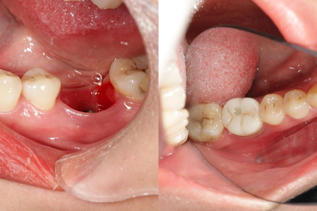 Giắt thức ăn sau khi trồng răng implant - Bài toán đã có lời giải ảnh 3