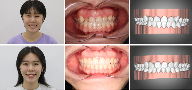 Yên tâm niềng răng nhờ biết trước kết quả điều trị với công nghệ X-Matrix! ảnh 1