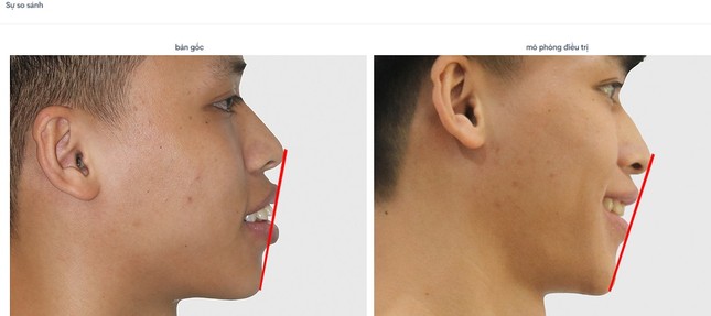 Yên tâm niềng răng nhờ biết trước kết quả điều trị với công nghệ X-Matrix! ảnh 2
