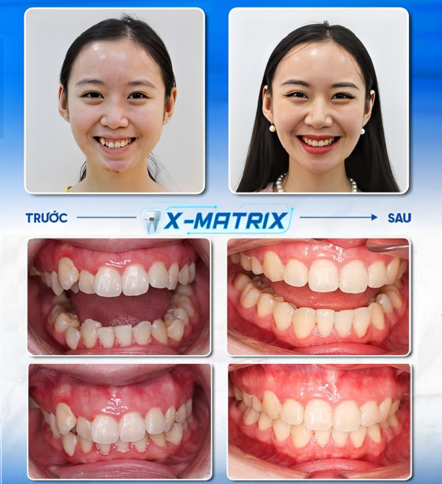 Yên tâm niềng răng nhờ biết trước kết quả điều trị với công nghệ X-Matrix! ảnh 3